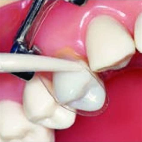 Facial Slot Class II Restorations: A Conservative Technique .
